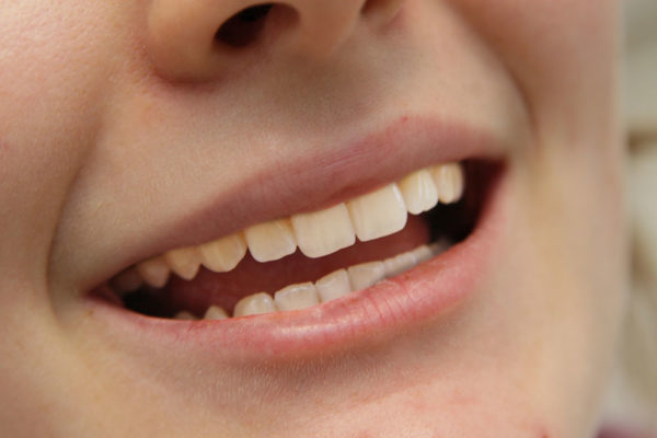 Lächeln Zahnarztpraxis Kandt Flöha Parodontologie